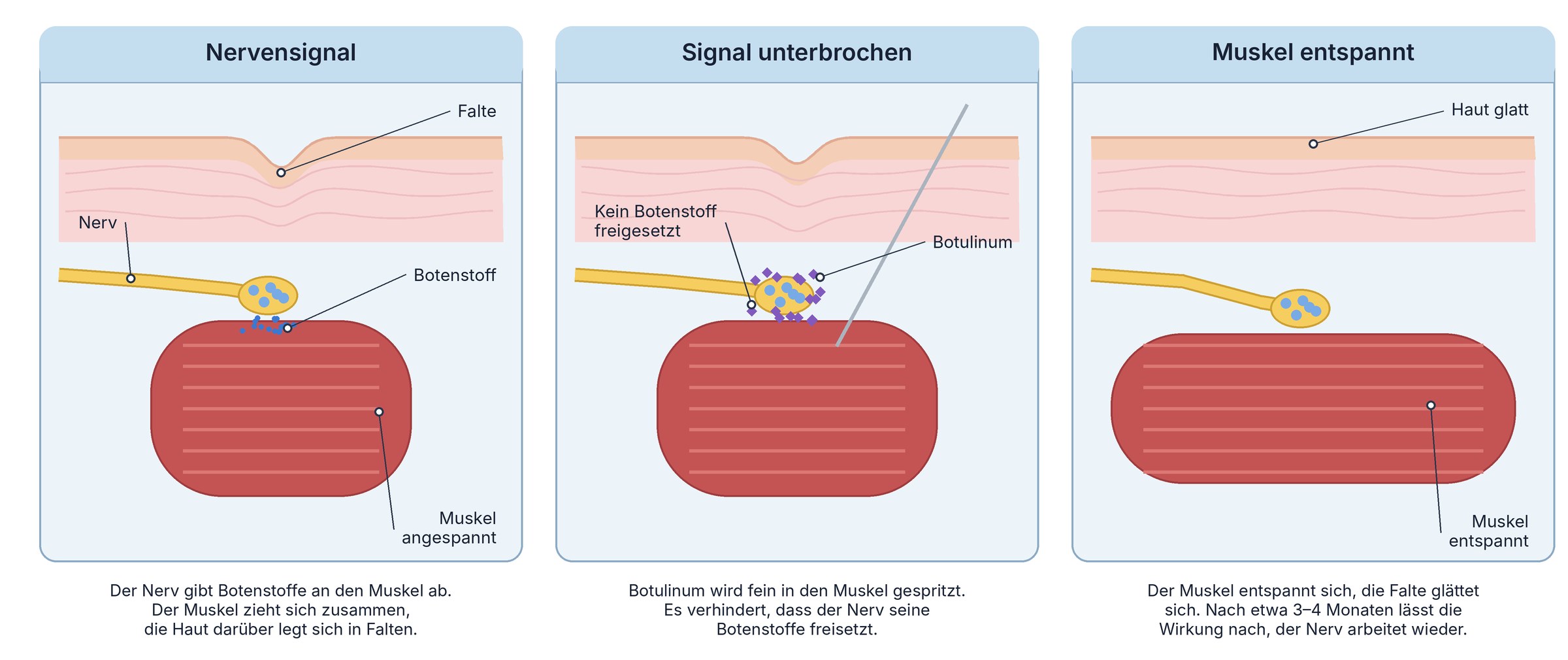 Grafik in drei Schritten: Der Nerv gibt Botenstoffe an den Muskel ab, der Muskel spannt sich an und die Haut legt sich in Falten. Botulinum unterbricht die Freisetzung der Botenstoffe. Der Muskel entspannt sich und die Haut wird glatt.