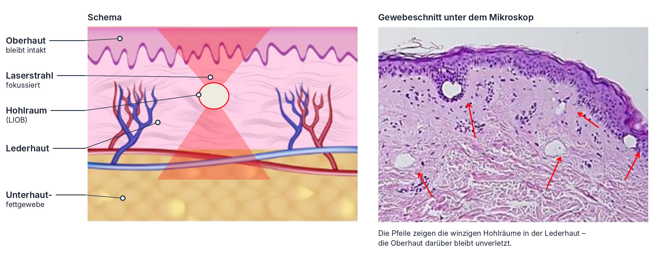 Links Schema, rechts Gewebeschnitt: Der fokussierte Laserstrahl des Picostar erzeugt in der Lederhaut winzige Hohlräume (LIOB), die Oberhaut bleibt intakt.