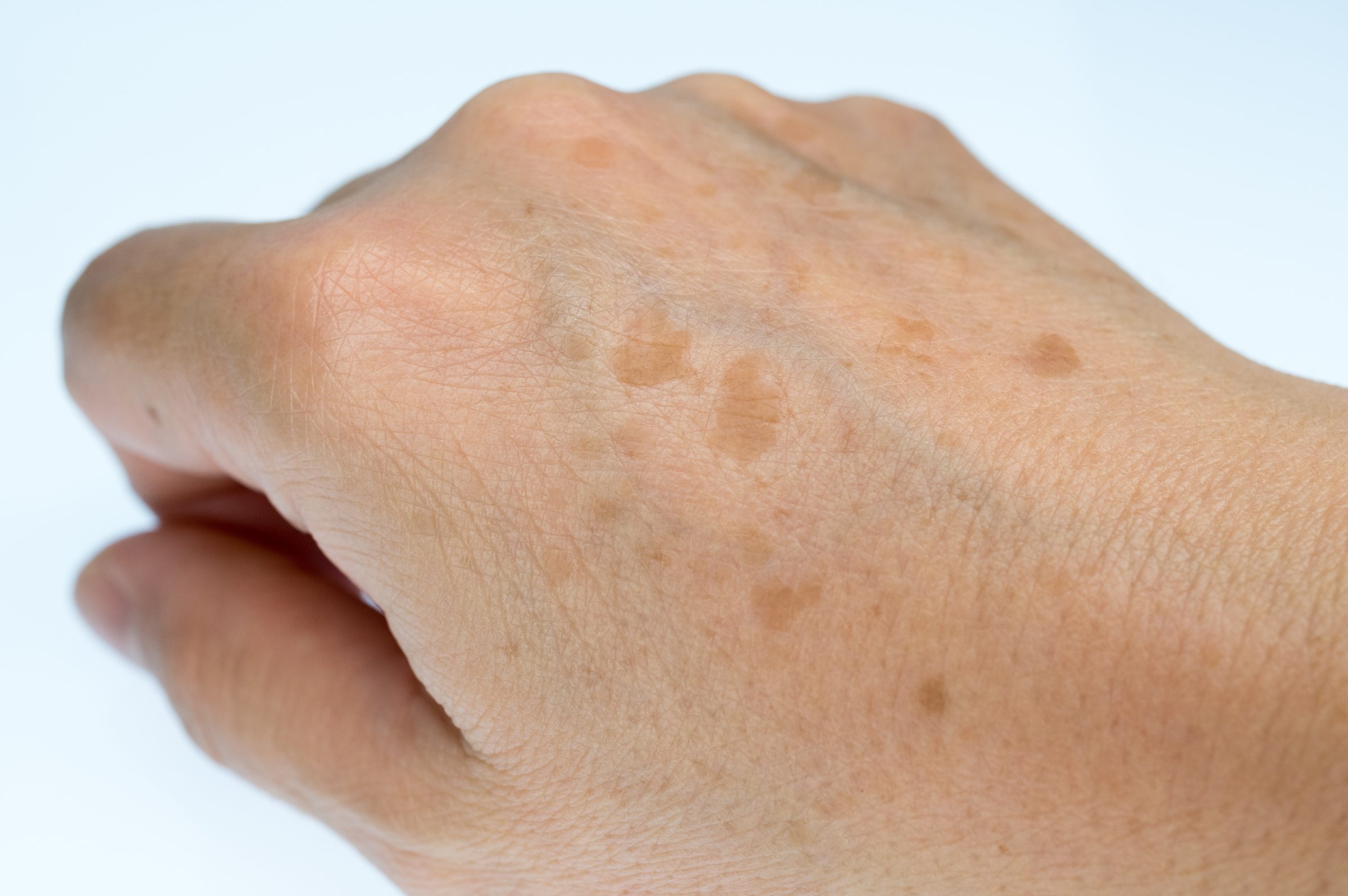 Handrücken mit Altersflecken