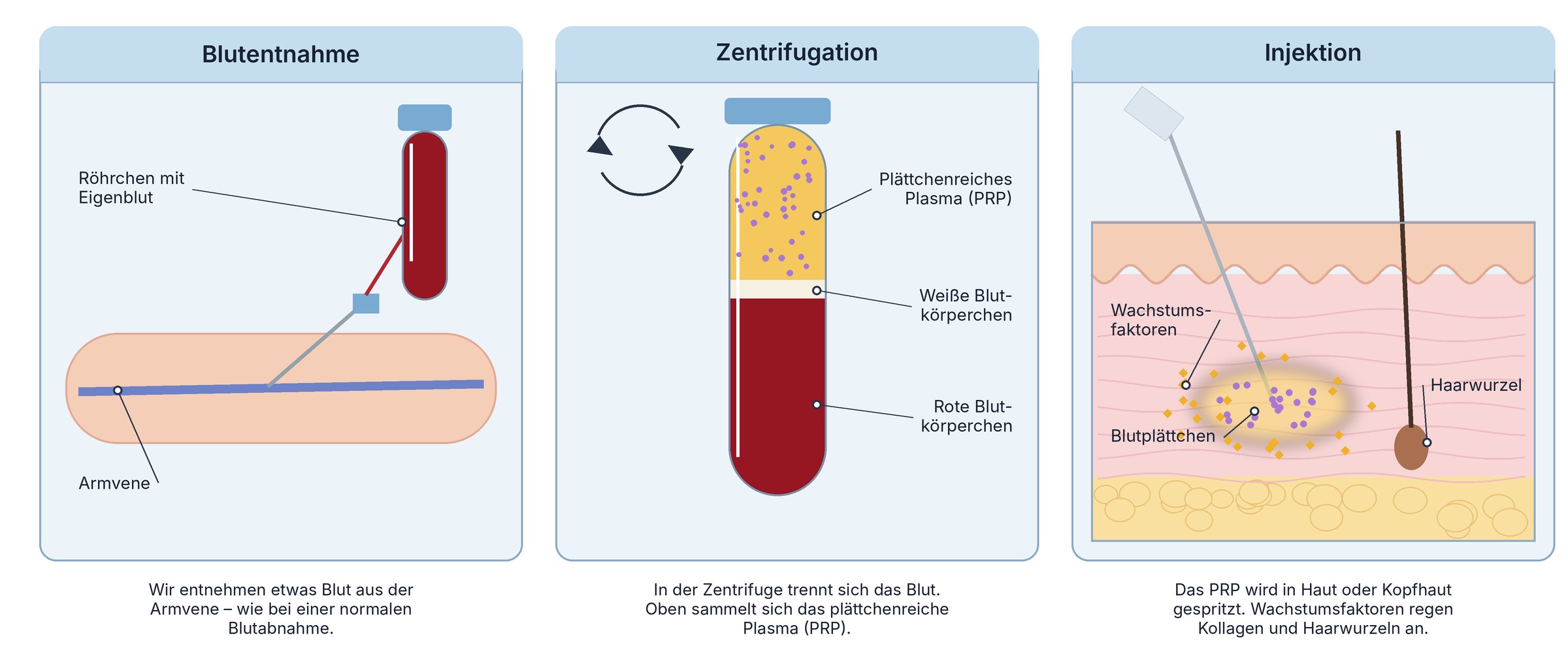 Grafik in drei Schritten: Blutentnahme aus der Armvene, Zentrifugation trennt das Blut in plättchenreiches Plasma, weiße und rote Blutkörperchen, Injektion des PRP in die Haut, wo Wachstumsfaktoren Kollagen und Haarwurzeln anregen.